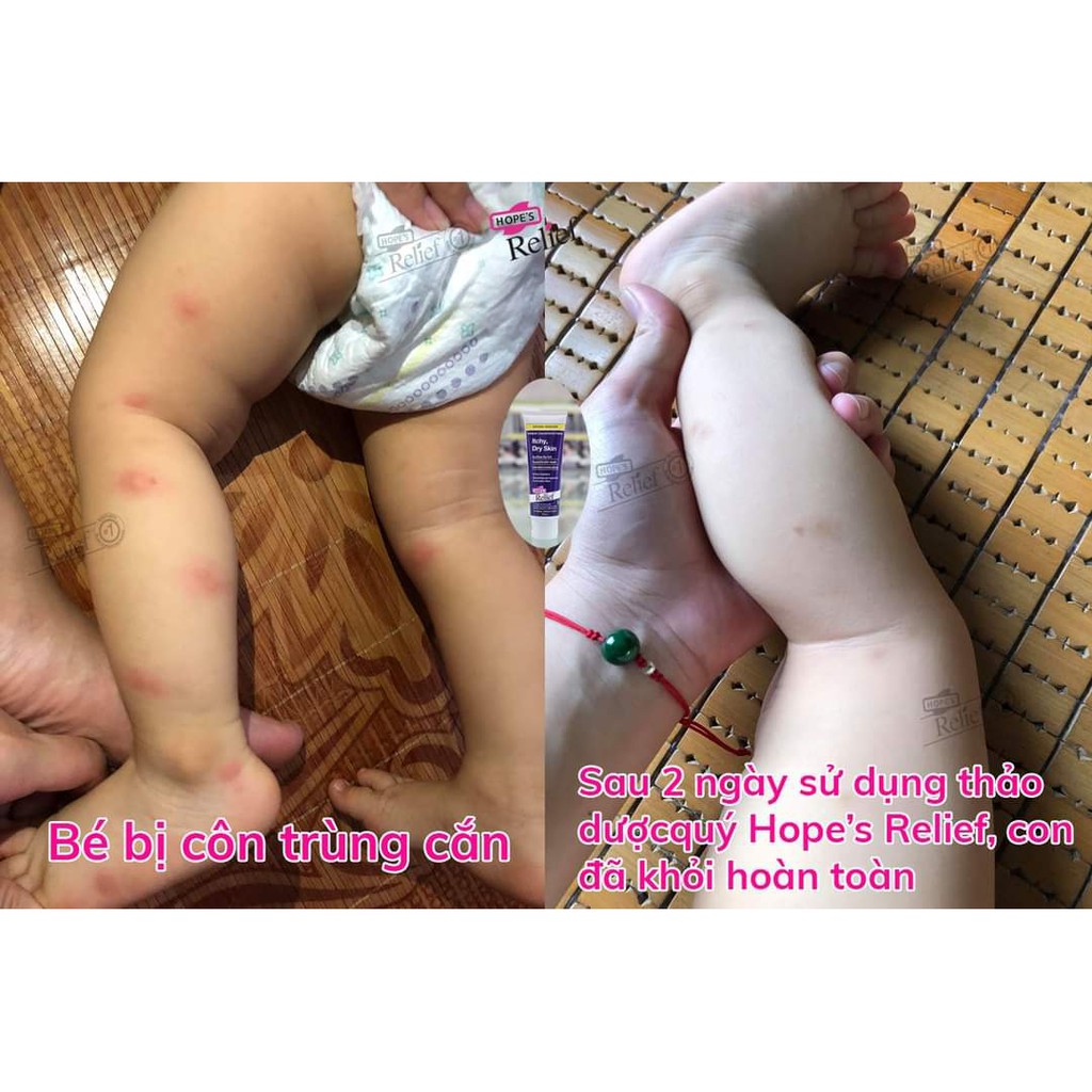 ✅ [HÀNG CÓ SẴN] Kem đa năng thảo dược Hope’s Relief hỗ trợ da khô ngứa, eczema, vảy nến (60g)