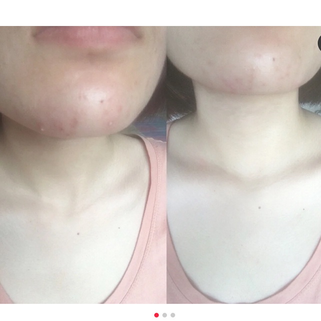 Kem Giảm Mụn Chuyên Biệt lion pair acne cream 24g acne derm
