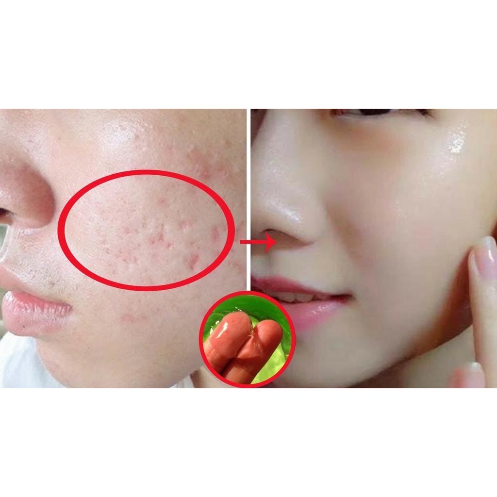 Kem Xóa Sẹo Strataderm Scar Therapy Gel 10g - Nhập Khẩu Chính Hãng Thụy Sỹ