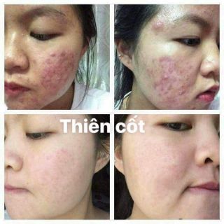 THUỐC BẮC TÁI TẠO DA THIÊN CỐT