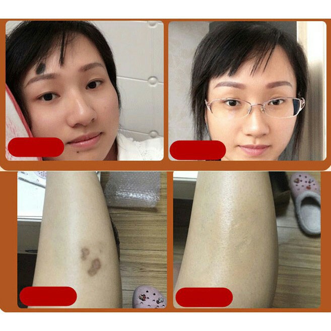 Kem che sẹo 2 mầu Demacare | BigBuy360 - bigbuy360.vn