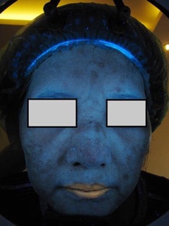 đèn soi da wood