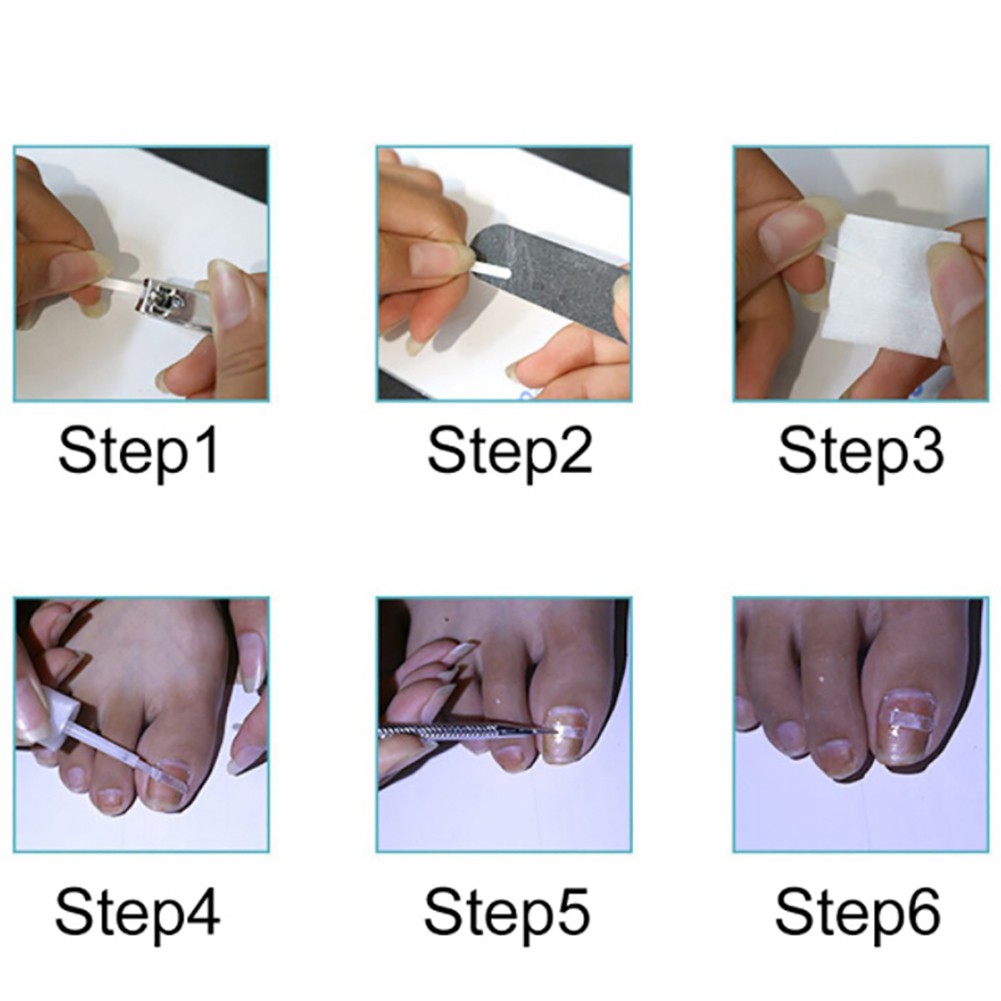 Keo dán điều chỉnh móng chân chuyên dụng 8g