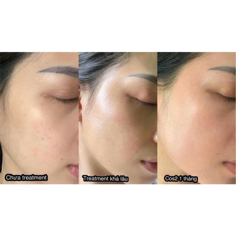 Kem nám Cosmelan2 - Chuyên về nám mảng ,nám chân sâu , đốm nâu , tàn nhang , đồi mồi , da không đều màu