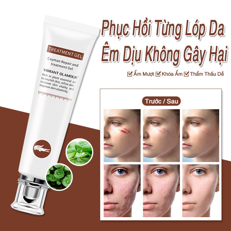 VIBRANT GLAMOUR KEM LÀM MỜ SẸO LÀM MỜ SẸO DO MỤN PHỤC HỒI VÀ TÁI TẠO DA MỜ RẠN DA SAU SINH SCAR TREATMENT GEL