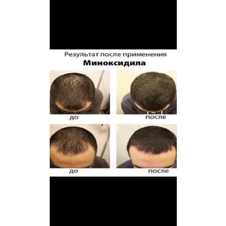 Xịt Kích Thích Mọc Tóc & Hói EKSIDERM NGA