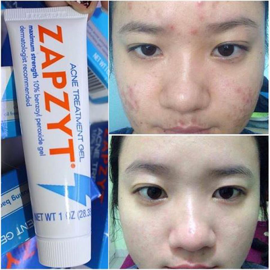 Kem Chấm Mụn ZAPZYT Acne Treatment Gel 10% Benzoyl Peroxide