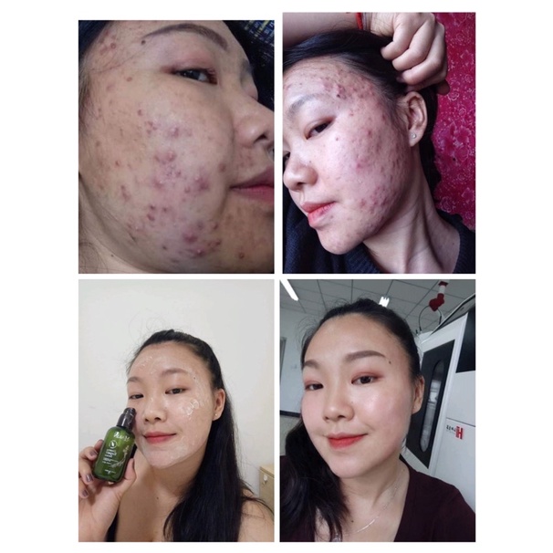 Combo Bột Rửa Mặt và Tái Tạo Da Mqskin, thay da nhân sâm giảm thâm nám, ngăn ngừa mụn