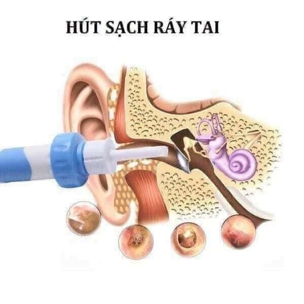 DỤNG CỤ LẤY/HÚT RÁY TAI THẦN THÁNH I-EARS NHẬT BẢN