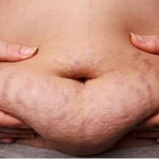 Gel tan mỡ Vy&body ( Cam kết hàng chính hãng )