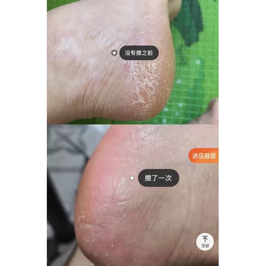 Kem URÊ BAOZHONGBAO Đánh Bay Viêm Lỗ Chân Lông Giúp Trắng Da Mịn Màng Dưỡng Ẩm Căng Bóng Da Kem Dưỡng Trắng