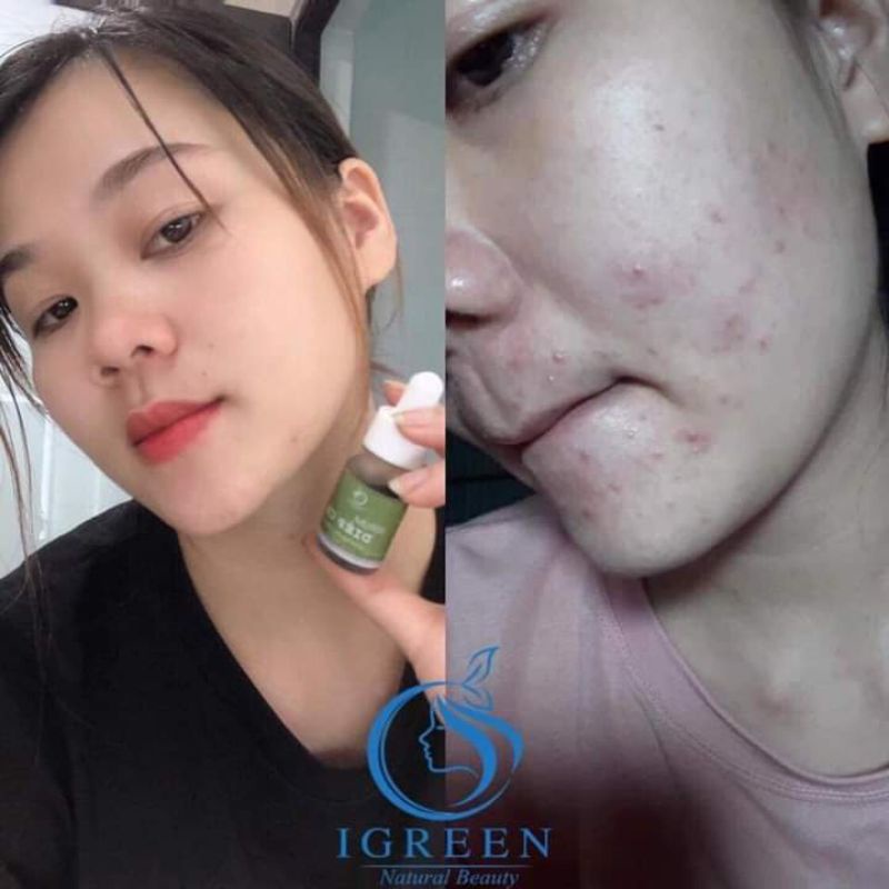 Serum dưỡng da chính hãng IGREEN 10ml chiết xuất từ diếp cá giảm mờ thâm sáng da không gây kích ứng