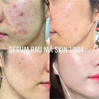 Serum Rau Má Centella Skinn1004 100ml