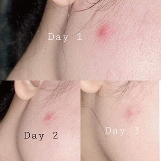 [Bản Cải Tiến 2021] Serum Lumos Acne Ngừa Mụn