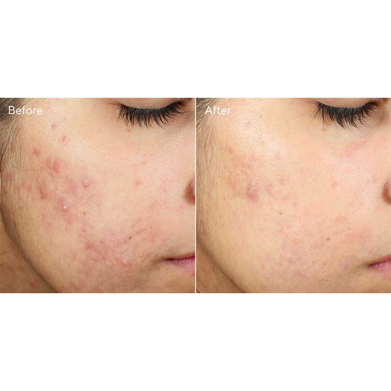 [ Hàng công ty, date xa] Serum làm mờ thâm nám và lấp đầy sẹo rỗ Murad InvisiScar Resurfacing Treatment