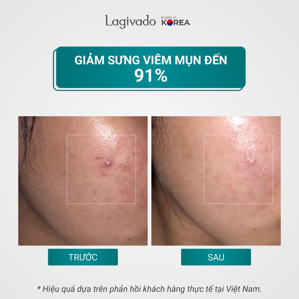 [Hàng chính hãng] - Tinh chất serum giảm mụn, mờ thâm Hàn Quốc Lagivado Dr. ATreat Serum 30 ml