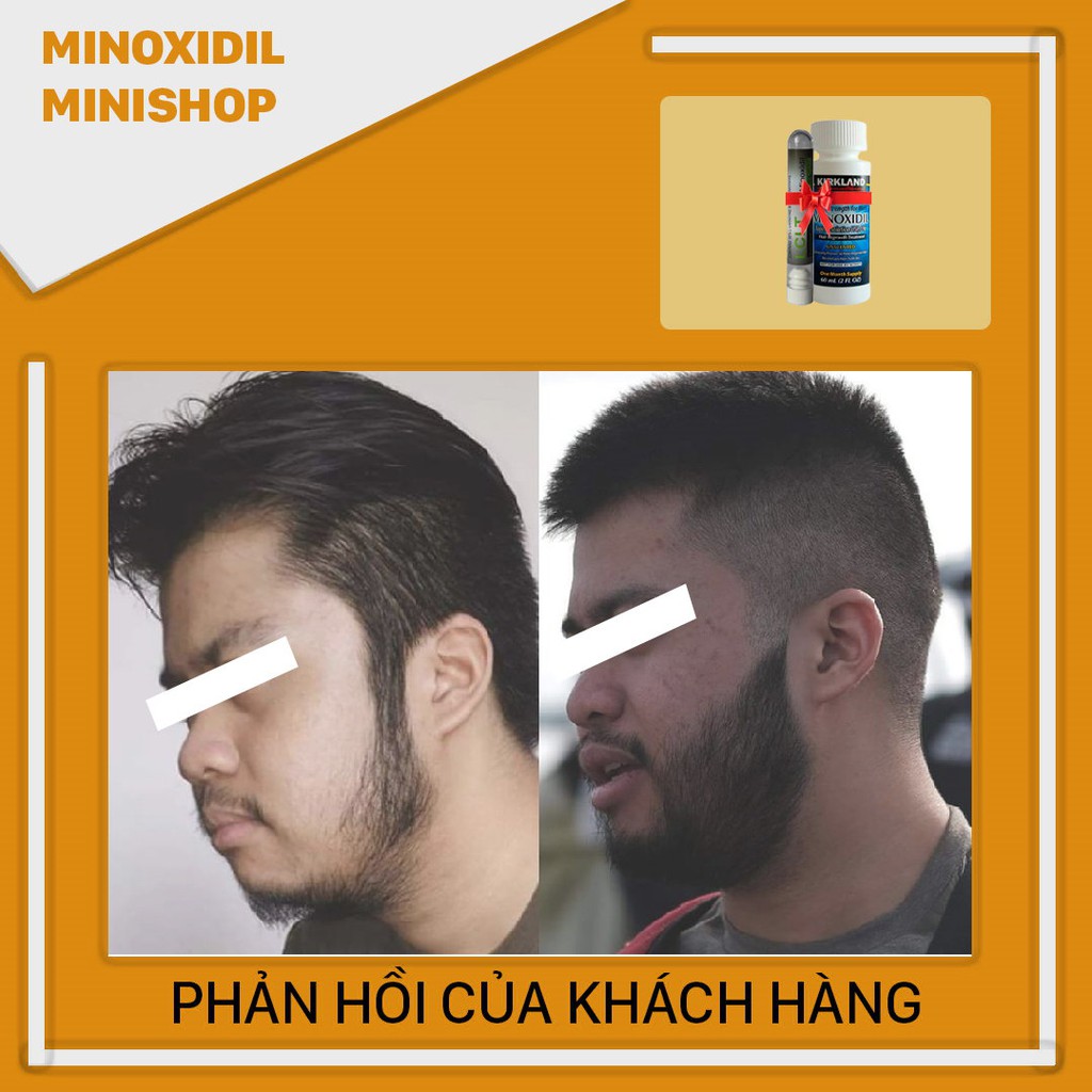 Minoxidil 5% lỏng combo bột LCLT giúp mọc râu nhanh