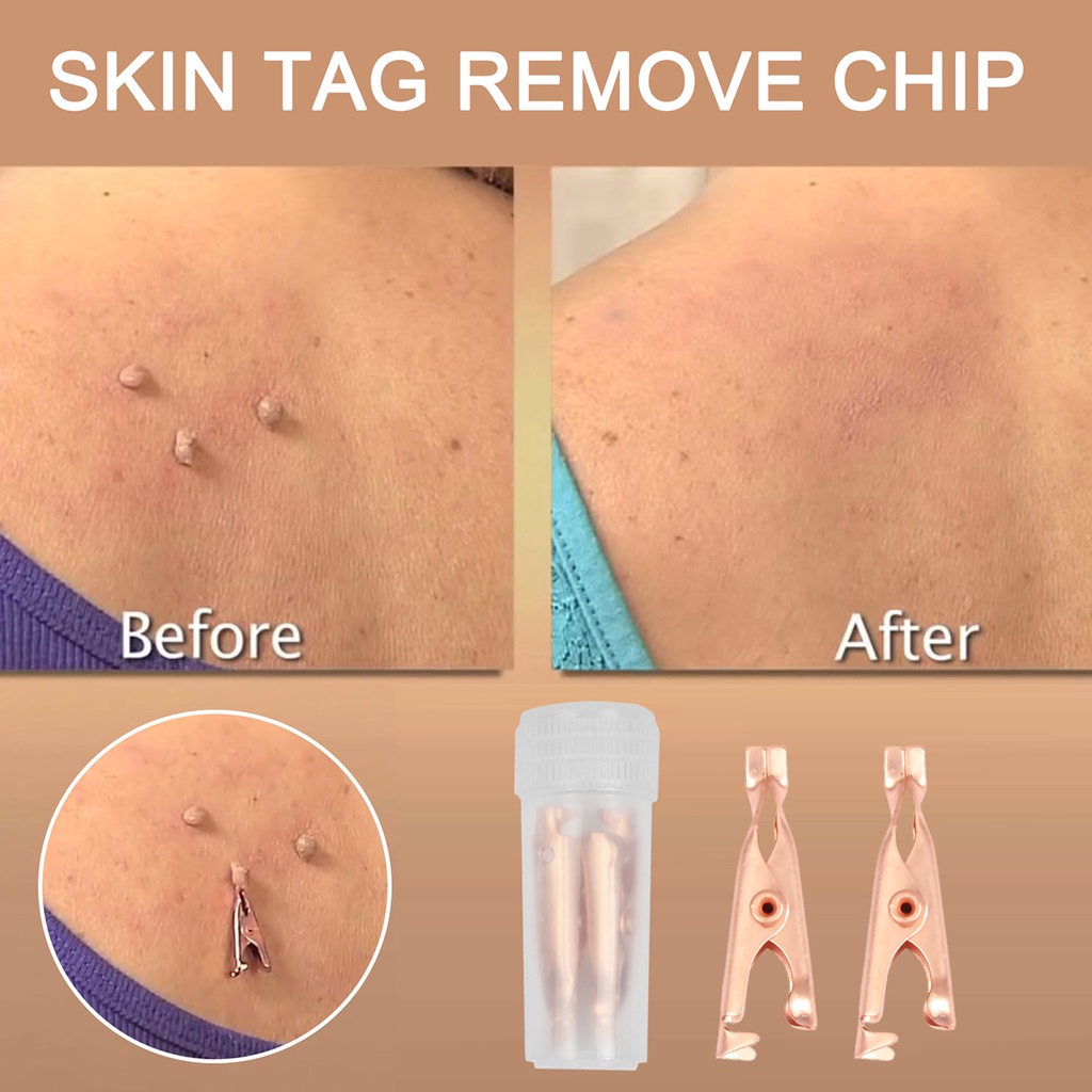 Dụng Cụ Hỗ Trợ Giảm Mụn Đầu Đen / Hình Xăm Dạng Kẹp Tiện Dụng