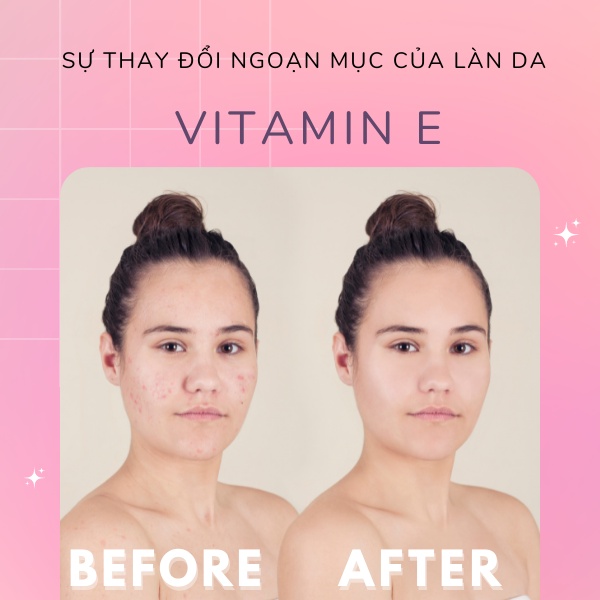Vitamin E đỏ viên uống đẹp da giảm nám mờ nhăn chống lão hoá