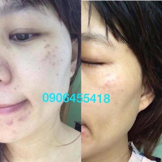 Chấm nám chân sâu , nám đinh
