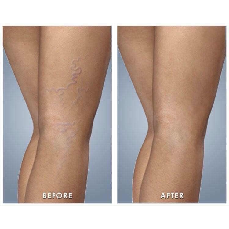 Kem bôi giãn tĩnh mạch chân Venen Gel Mivolis