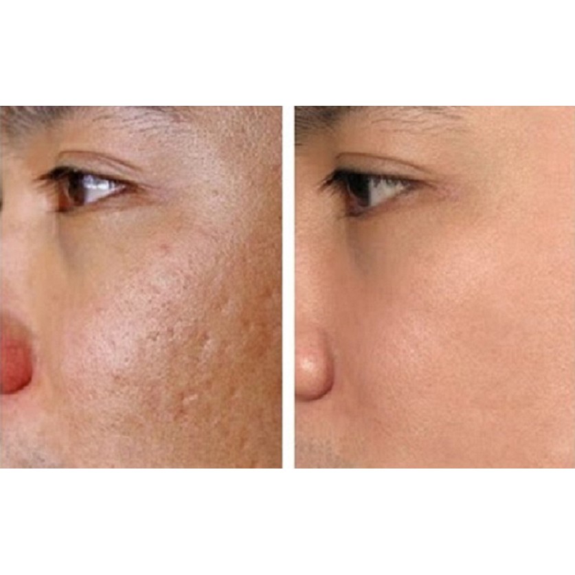 KEM CẤP ẨM & SĂN CHẮC DA MẸ KEN DÀNH CHO DA KHÔ ,DA LĂN KIM, PHI KIM, BẮN LASER, PEEL