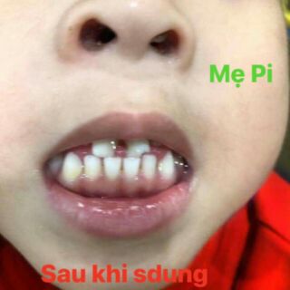 Kem bôi chống sâu răng , sún răng