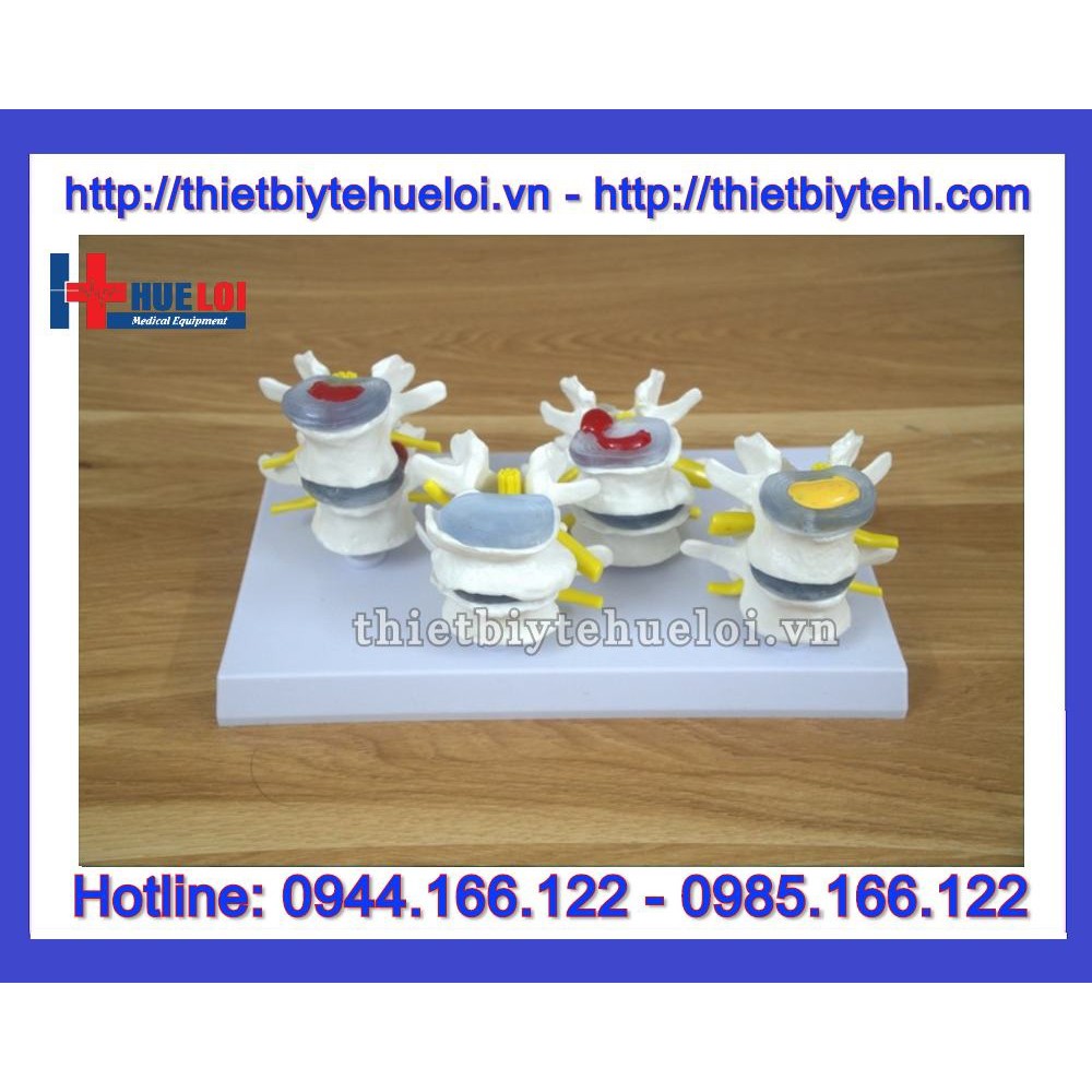 Mô hình thực hành giri phẫu bệnh lý đốt sống