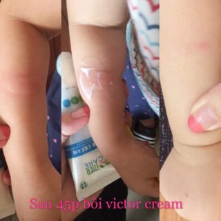 Kem chống - trị muỗi và côn trùng đốt (trị cả chấy nha)