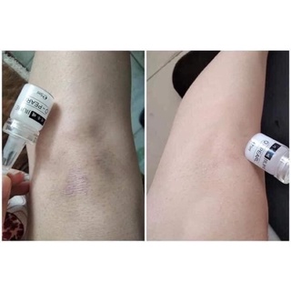 Giảm Thâm Jiuhe Bye Bye Melano
