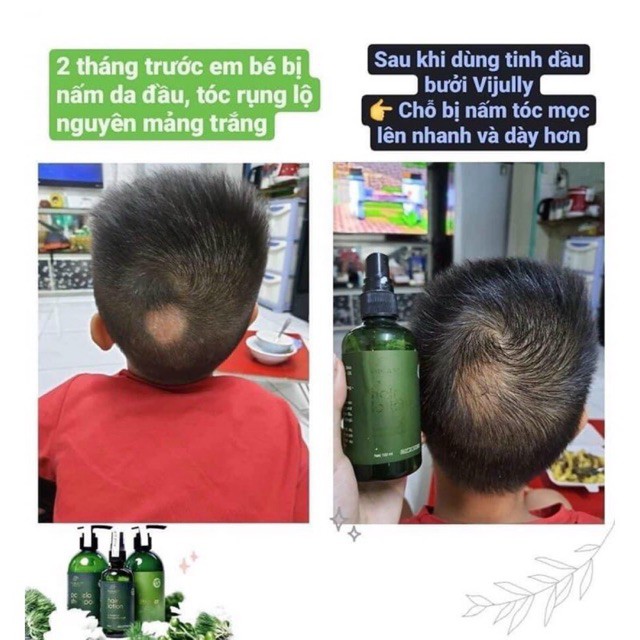 [Chính hãng] Dầu Gội Bưởi Vijully - Ngăn ngừa rụng tóc, giúp tóc nhanh dài