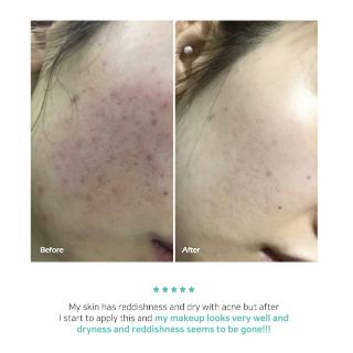 Dòng sản phẩm da mụn Byecom Pure Calming