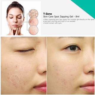 Chấm mụn T-Zone Spot Zapping Gel UK