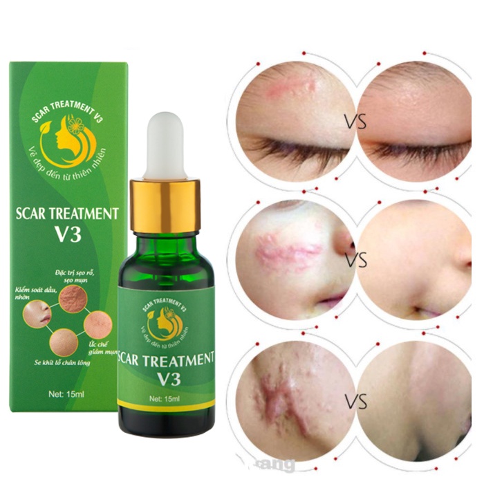 Serum Giảm sẹo lồi,rỗ,sẹo rỗ lâu năm - Hỗ trợ giảm vết rạn da, các vết sẹo thâm Scar Treatment V3