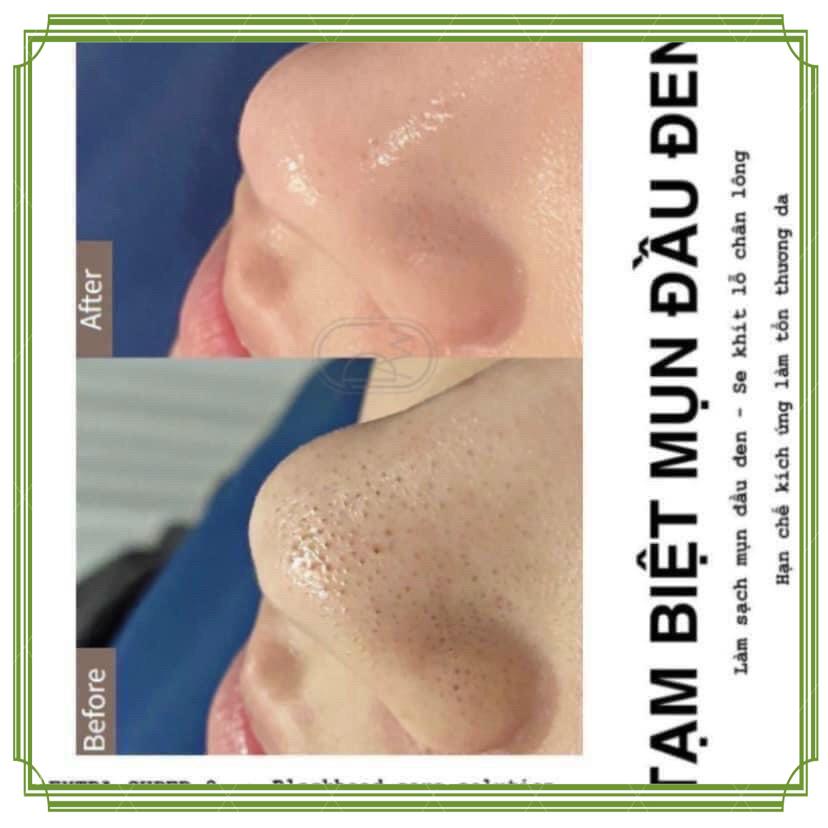 (FULL CHAI) DUNG DỊCH Ủ MỤN MEDIPEEL CHUYÊN DÙNG SPA | BigBuy360 - bigbuy360.vn