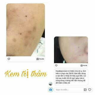 Kem Trị Thâm Handmade