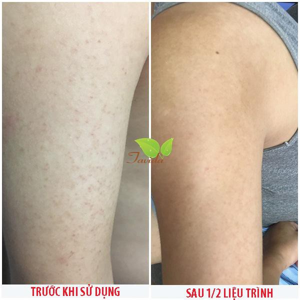 MEN VI SINH TAVIDA CHĂM SÓC LÀN DA VIÊM NANG LÔNG | BigBuy360 - bigbuy360.vn