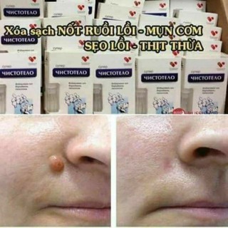 Tẩy mụn cóc ,mụn ruồi