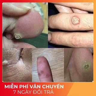 Dung dịch diệt mụn cơm, mụn cóc, sạn cá, mụn thịt của nga