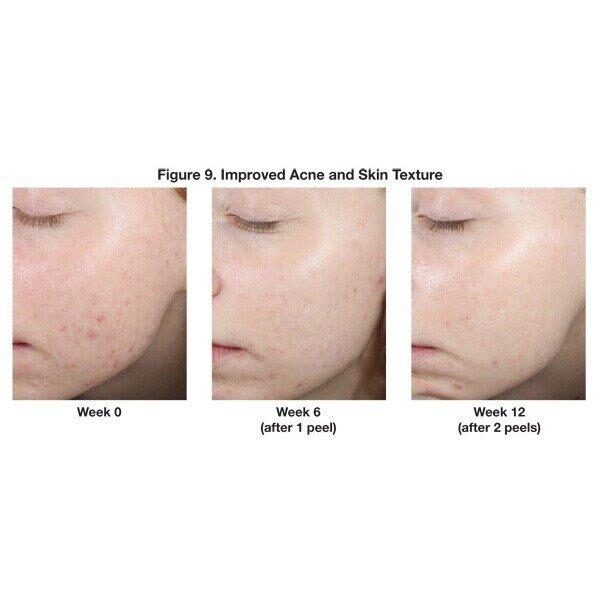 Neo.strata Dung Dịch Peel Tái Tạo Da Giảm Nếp Nhăn Chống Lão Hóa 1.5ML