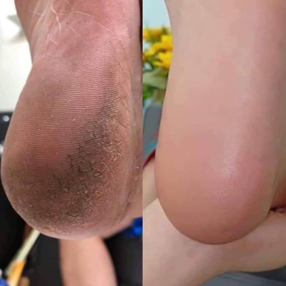 Dụng Cụ Chà, Dũa Gót Chân tiện dụng