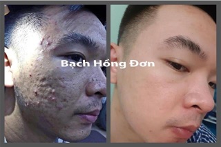 Combo Bạch Hồng Đơn phổ thông
