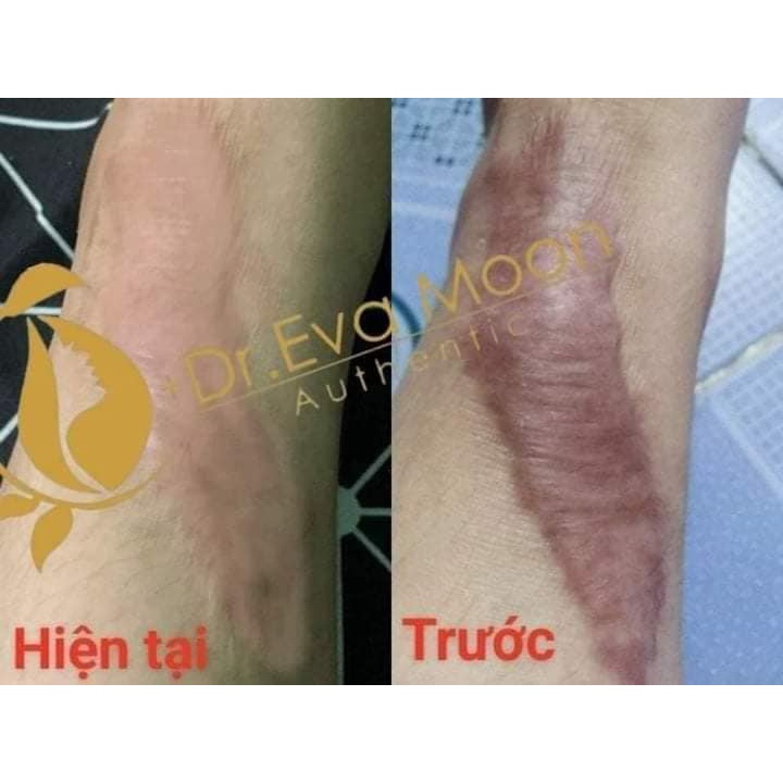 "GIÁ SỐC" Kem sẹo rỗ, sẹo thâm, sẹo rạn , sẹo thủy đậu