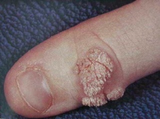 Mụn cơm, mụn cóc, mắt cá
