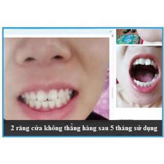 Niềng răng tại nhà