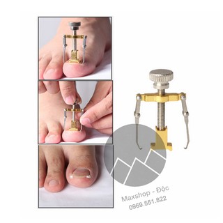 Bộ chữa móng chân chọc vào thịt đau đớn - móng chân bị quặp