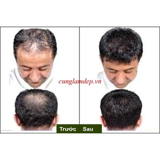 Serum Mọc Tóc Hiệu Quả HG9