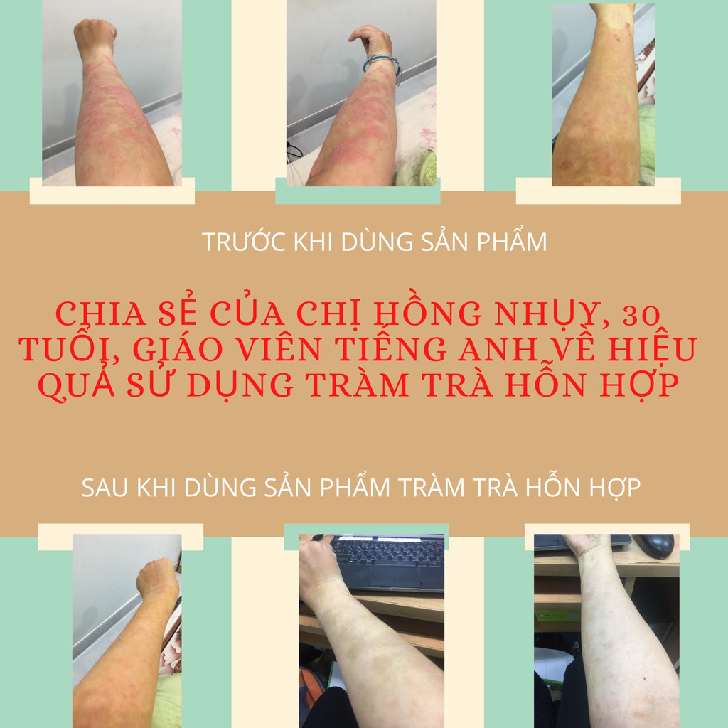 Tràm trà hỗn hợp ngăn ngừa vảy nến Aotanica