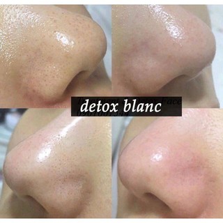 Mặt nạ detox blanc trắng da-thải độc chì