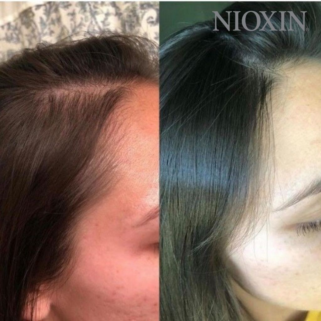 Bộ Chăm Sóc Tóc Nioxin 4 Dành Cho Tóc Nhuộm, Thưa Mỏng Và Rụng Nhiều Colored Treated Hair With Progressed Thinning